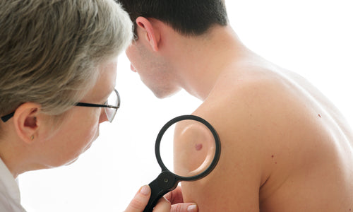 Dermatologist examines a mole