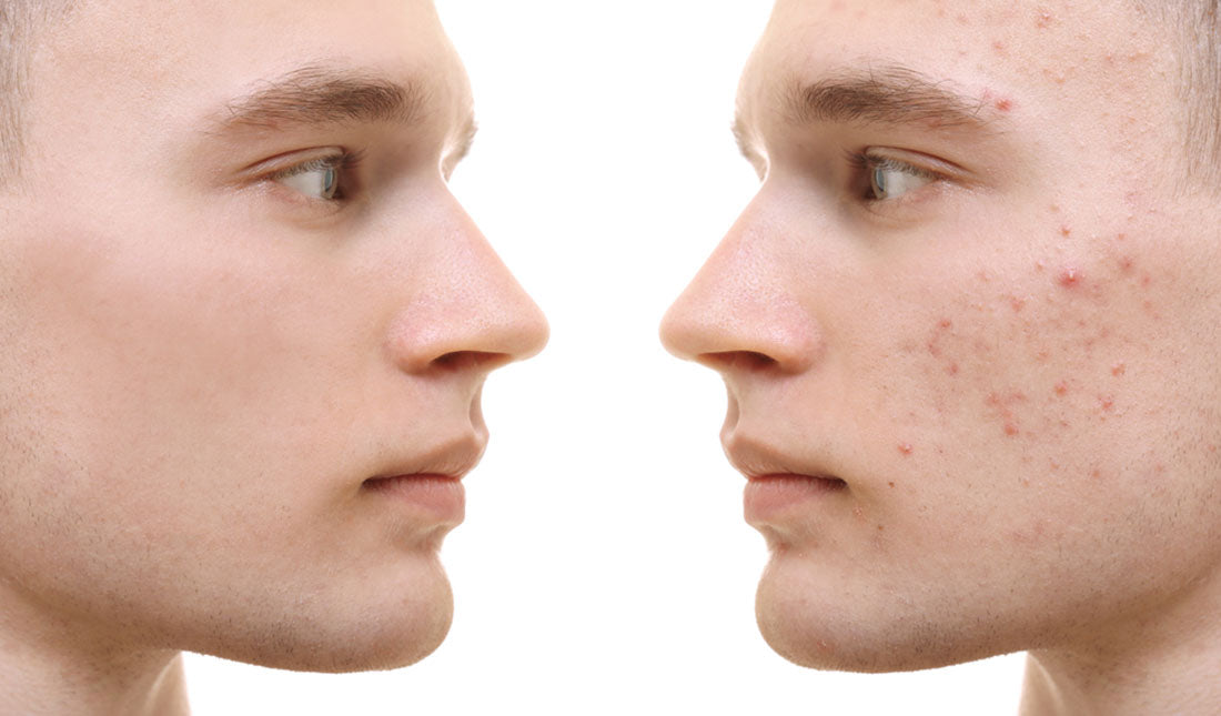 acne before and after