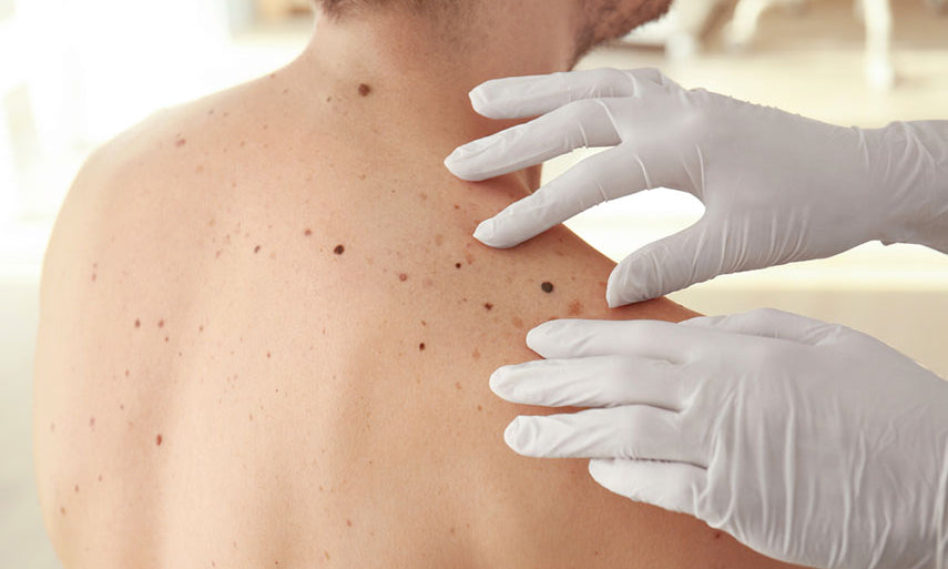 dermatologist checking moles on patients back