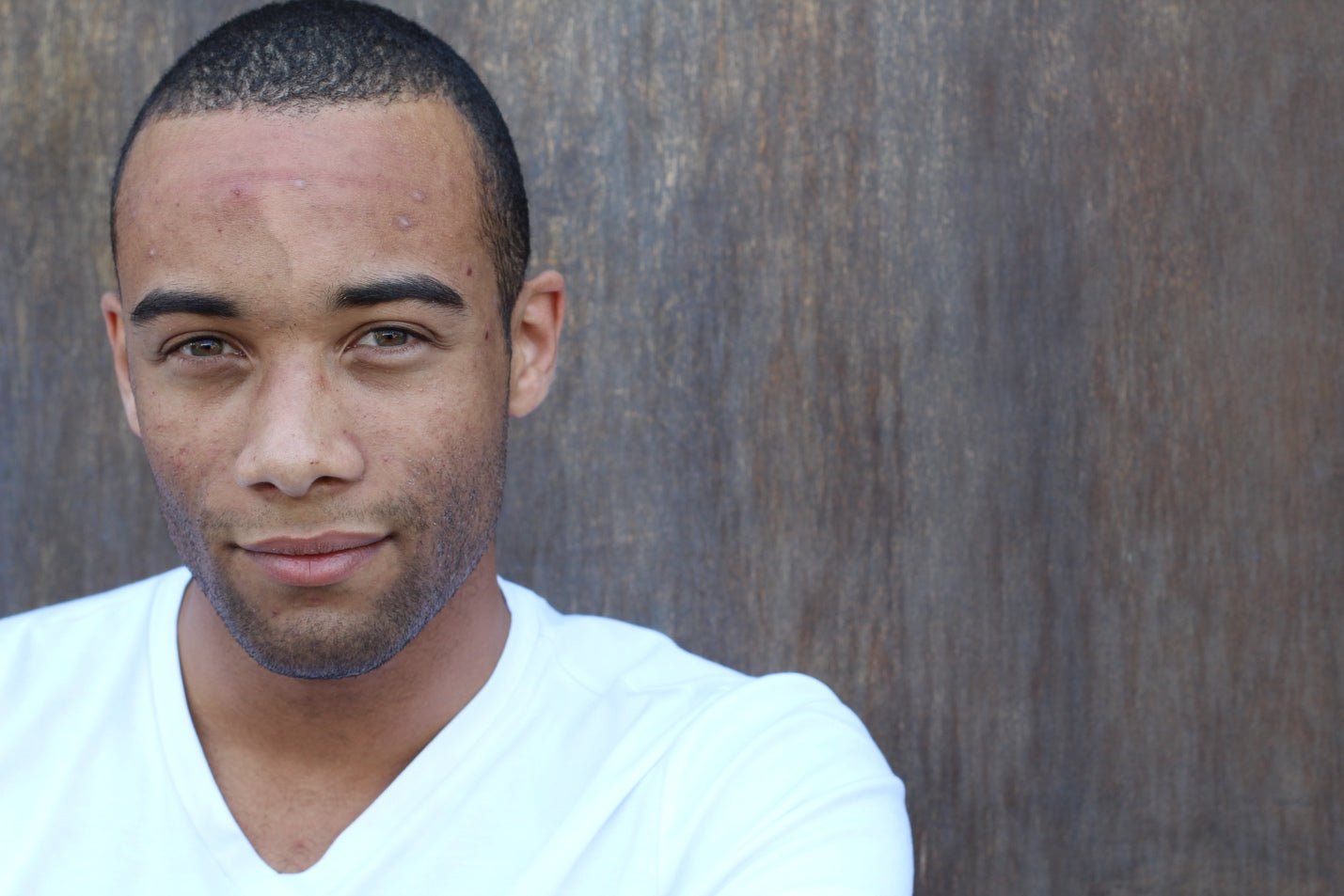 Man with facial acne standing against a wall