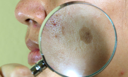 melasma magnified on face