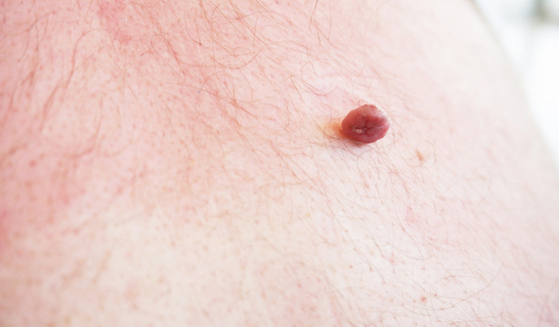 skin tag