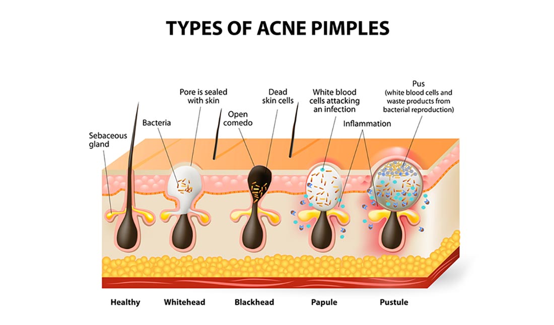 types of acne pimples illustration