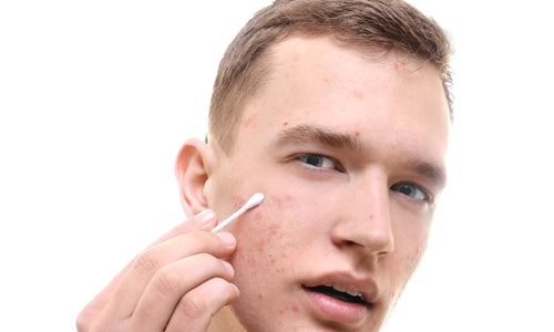 young man with problem skin